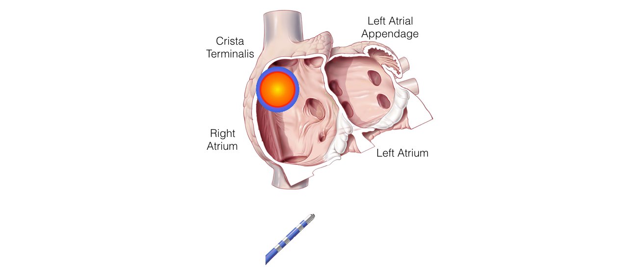 Atrial Tachycardia slide 4