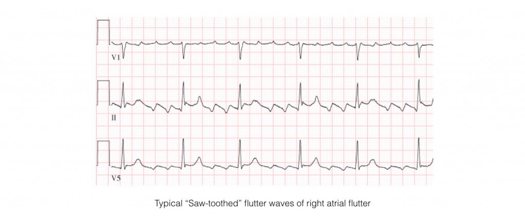flutter in chest cured