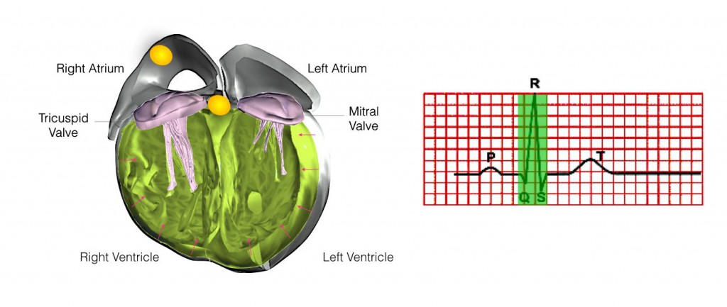right ventricle ablation flutter