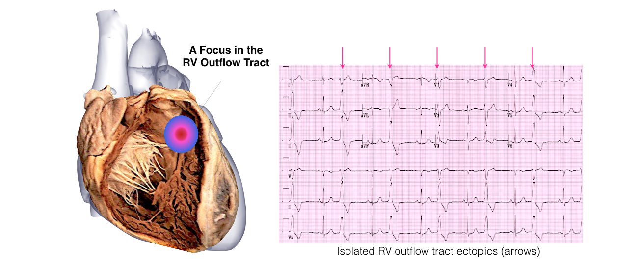 VT in Normal Hearts Slide 4