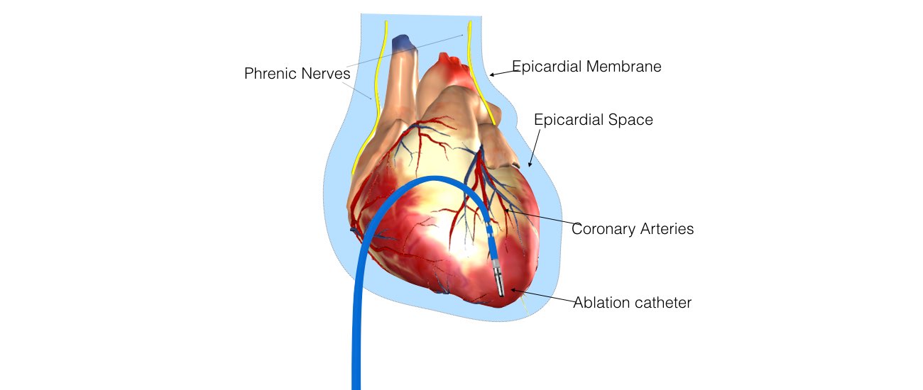 Ventricular tachycardia ablation