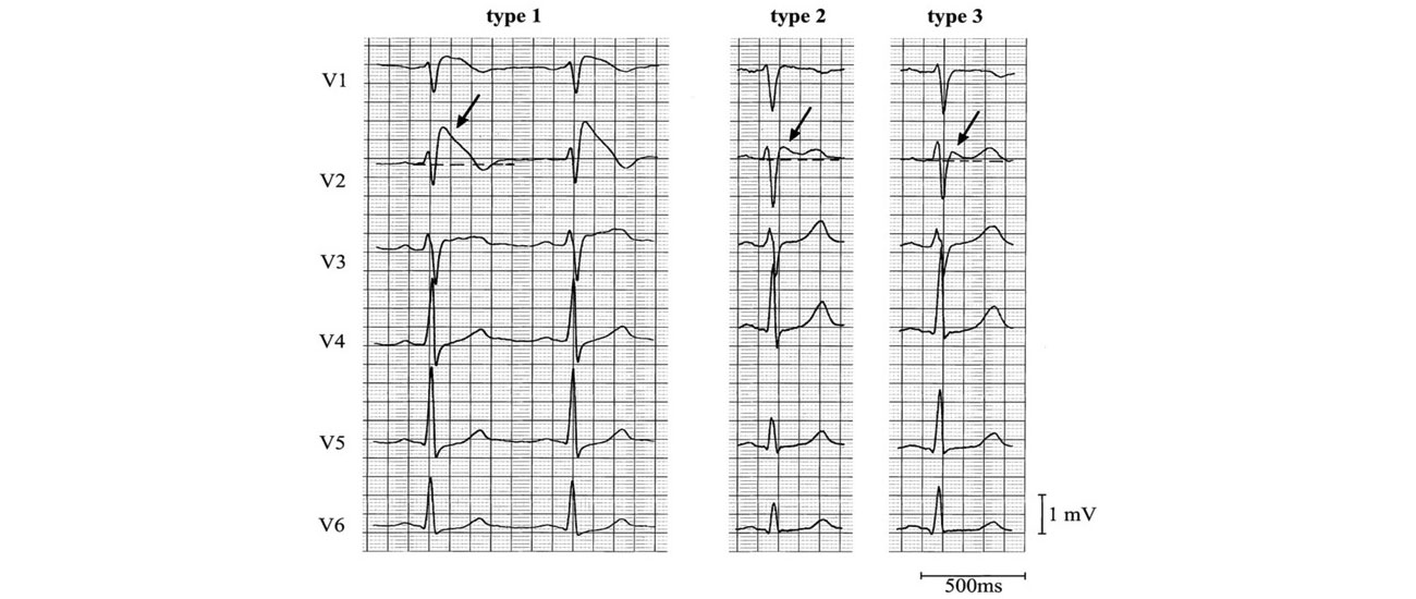 brugada syndrome types